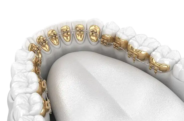 Aparat dentar lingual montat pe fața interioară a dinților, Smileway Timișoara
