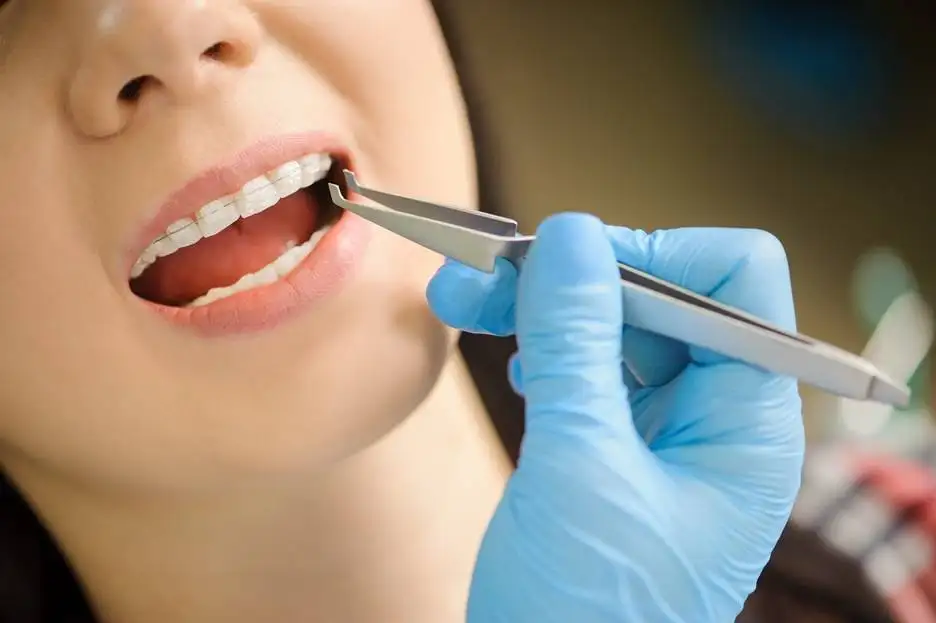 Aparat dentar fix cu brackeți din safir aplicat la clinica Smileway din Timișoara