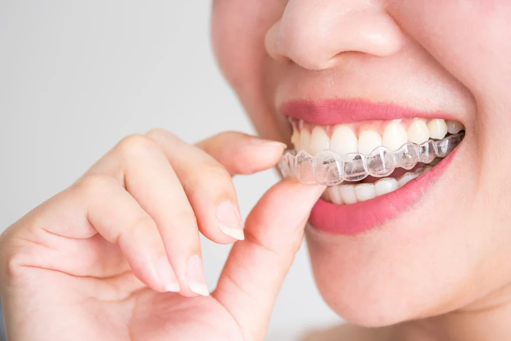 Aparat dentar invizibil Spark în rate la Smileway Timișoara