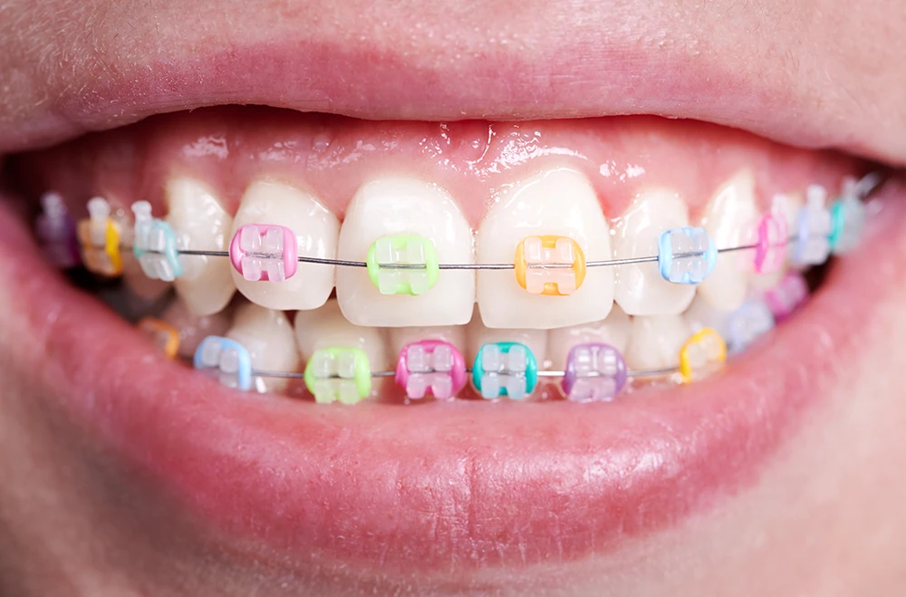 Aparat dentar safir în rate la clinica Smileway Timișoara