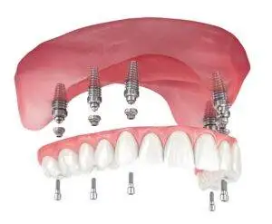 Pachet All-on-6 maxilar - Smileway