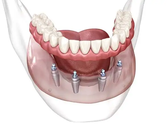 Pachet All-on-4 mandibulă - Smileway