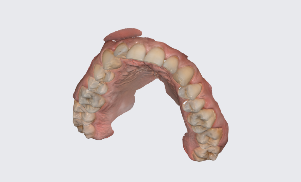 Amprentare 3D a danturii cu scanner intraoral la Smileway Timișoara
