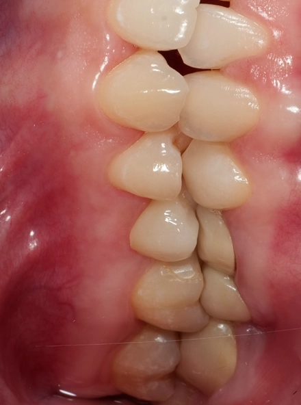 Coroană din zirconiu cimentată, integrată cu dinții vecini, caz realizat la clinica Smileway Timișoara