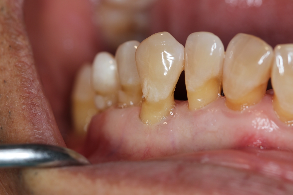 Retracție gingivală cu rădăcina dintelui expusă, consecință a inflamației cronice