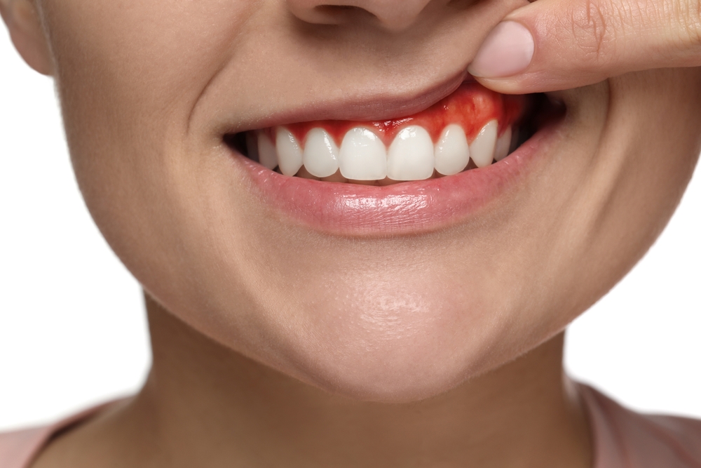 Gingie inflamată cu gingivită, cauzată de placa bacteriană neîndepărtată