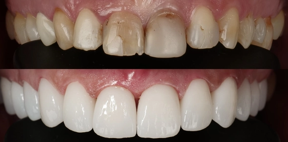 Cimentarea definitivă a fațetelor dentare sub microscop la Smileway Timișoara