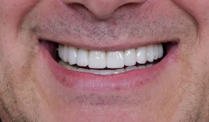 Lucrare protetică fixă definitivă zirconiu - Smileway