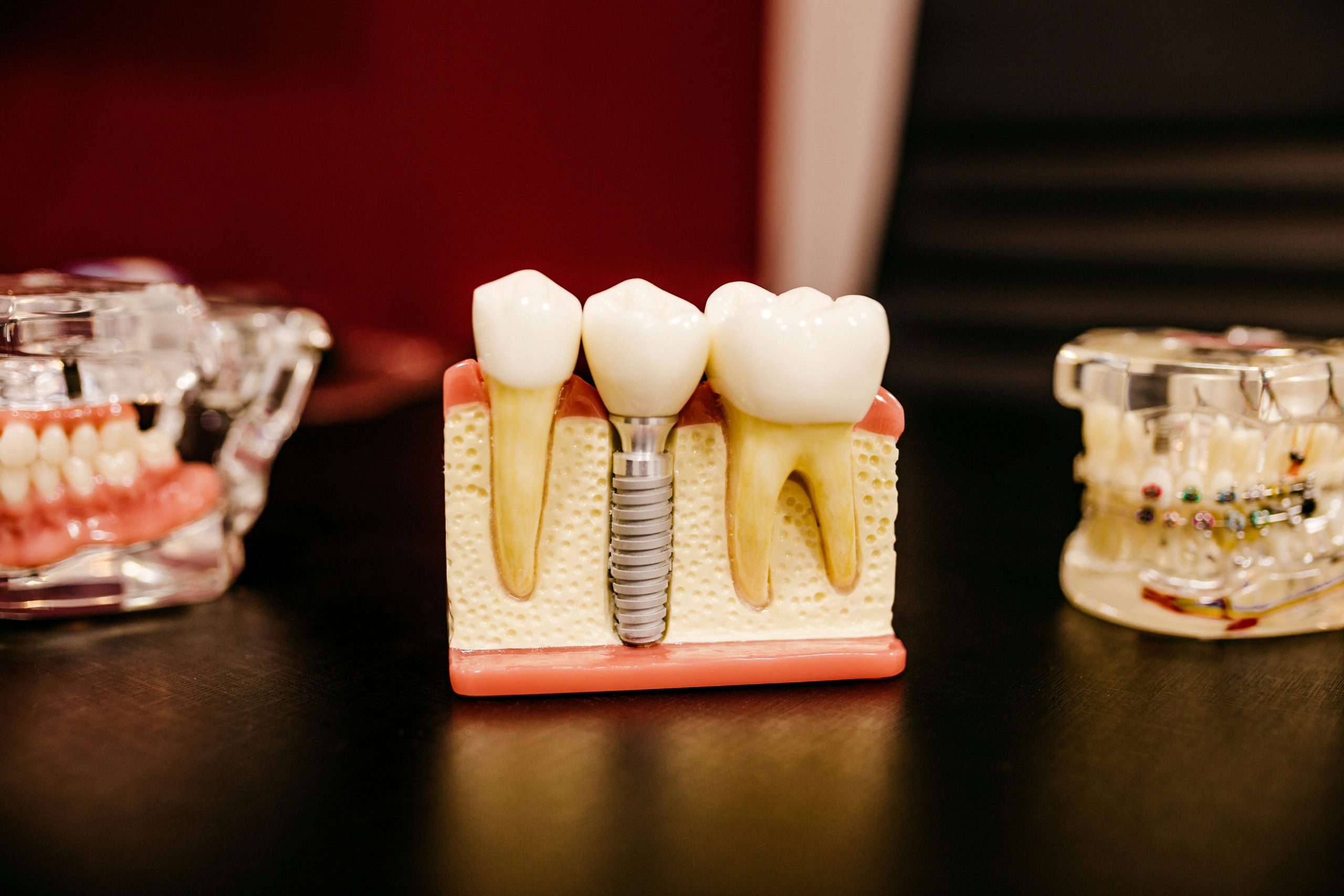 Descoperirea implantului și scanare pentru coroana dentară, la Smileway Timișoara