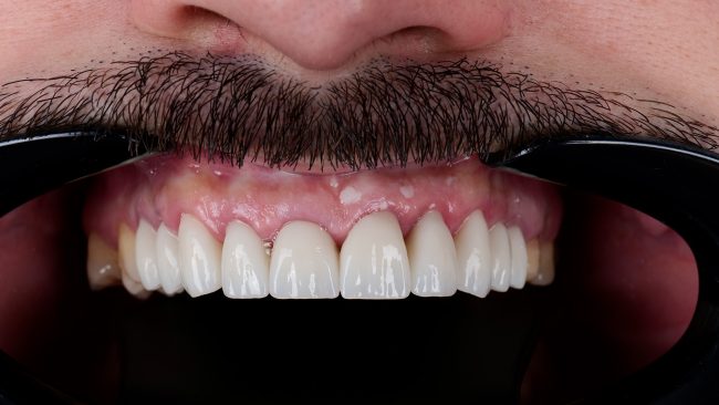 Detaliu intraoral după lucrare definitivă din zirconiu, Smileway Timișoara