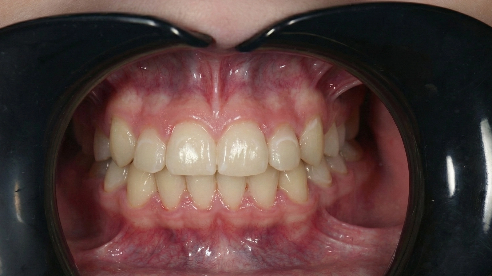 După tratamentul ortodontic la clinica Smileway Timișoara