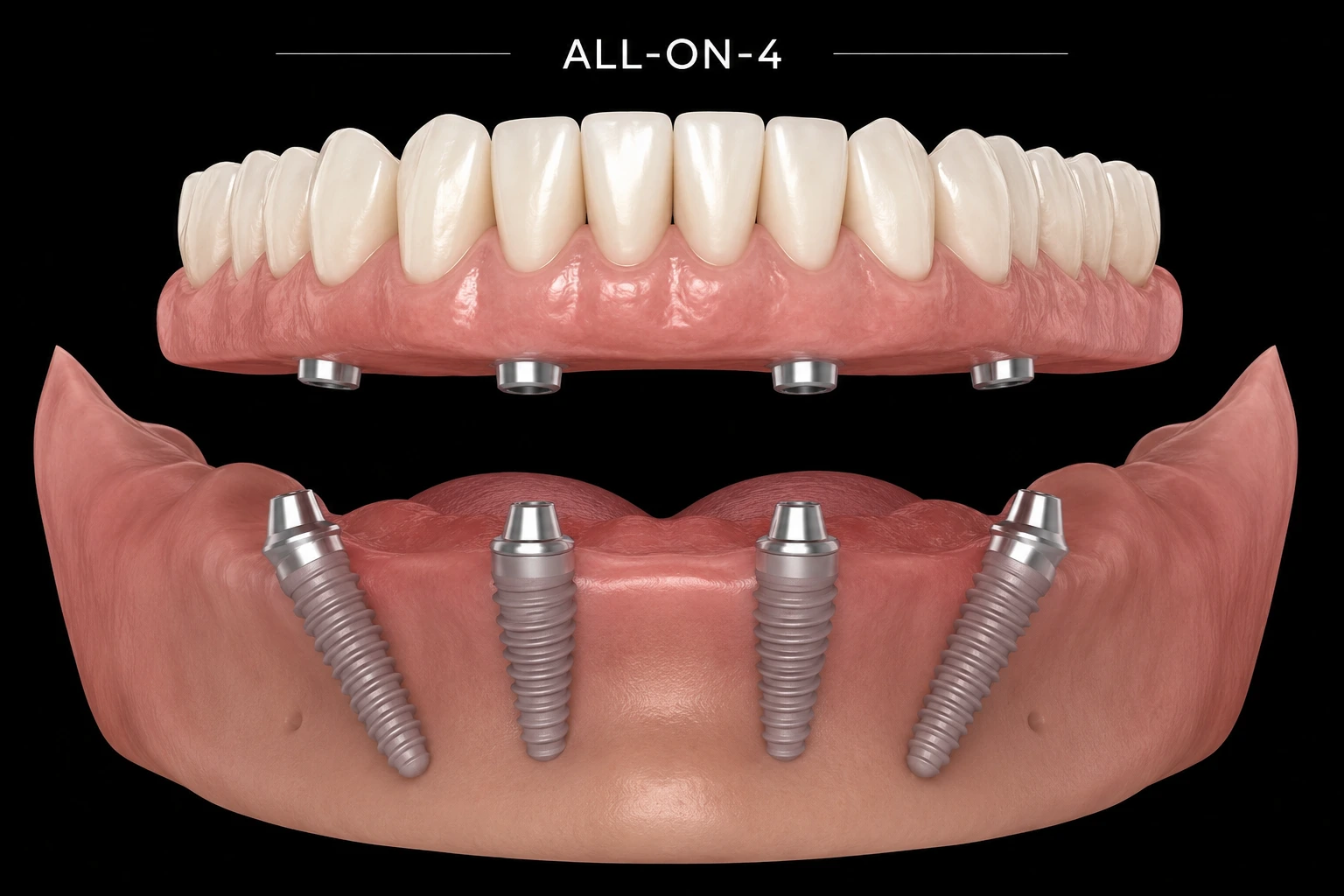 Inserarea celor 4 implanturi, All-on-4, la Smileway Timișoara