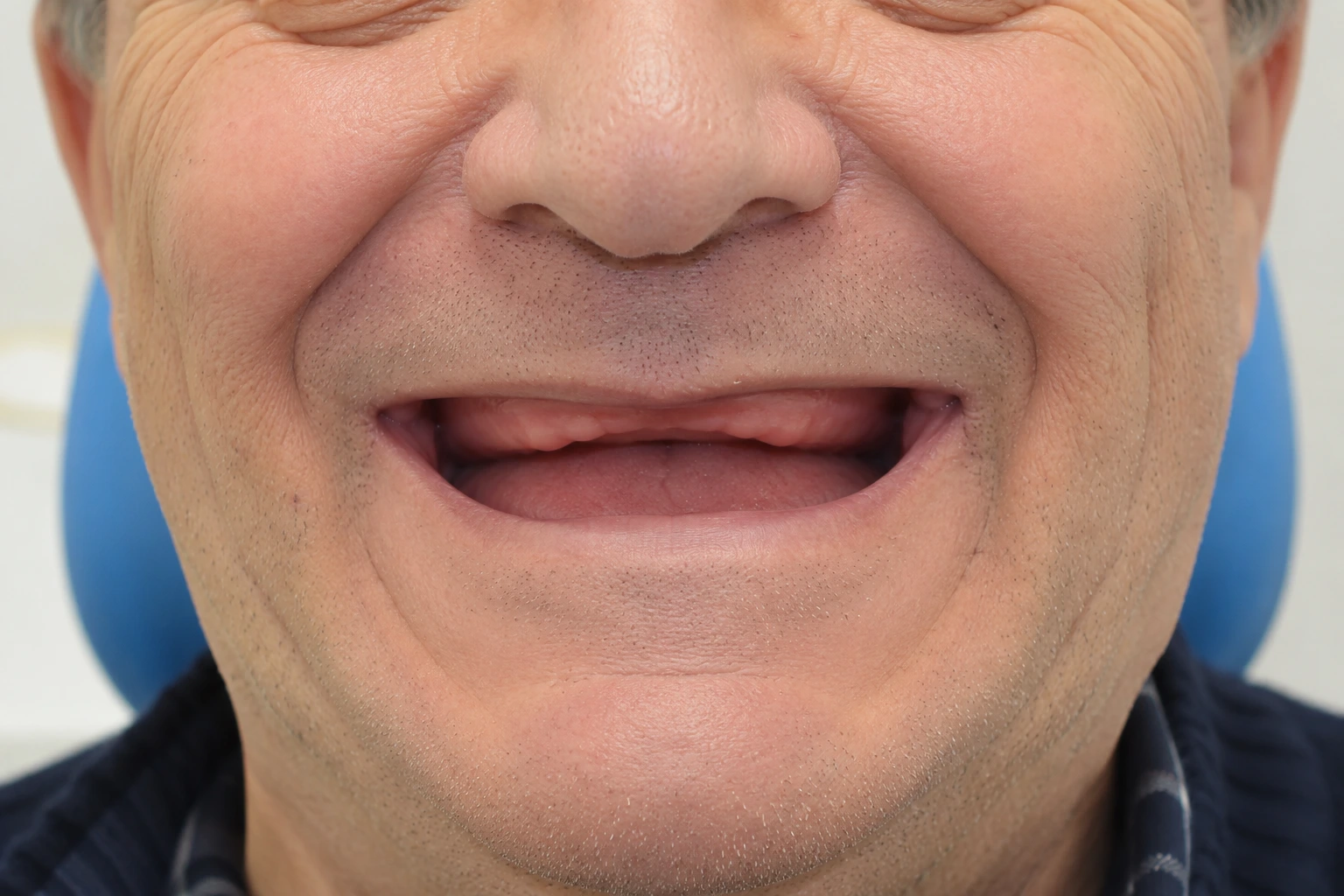 Arcadă edentată, pacient fără dinți, situație pentru dinți ficși pe implant la Smileway Timișoara