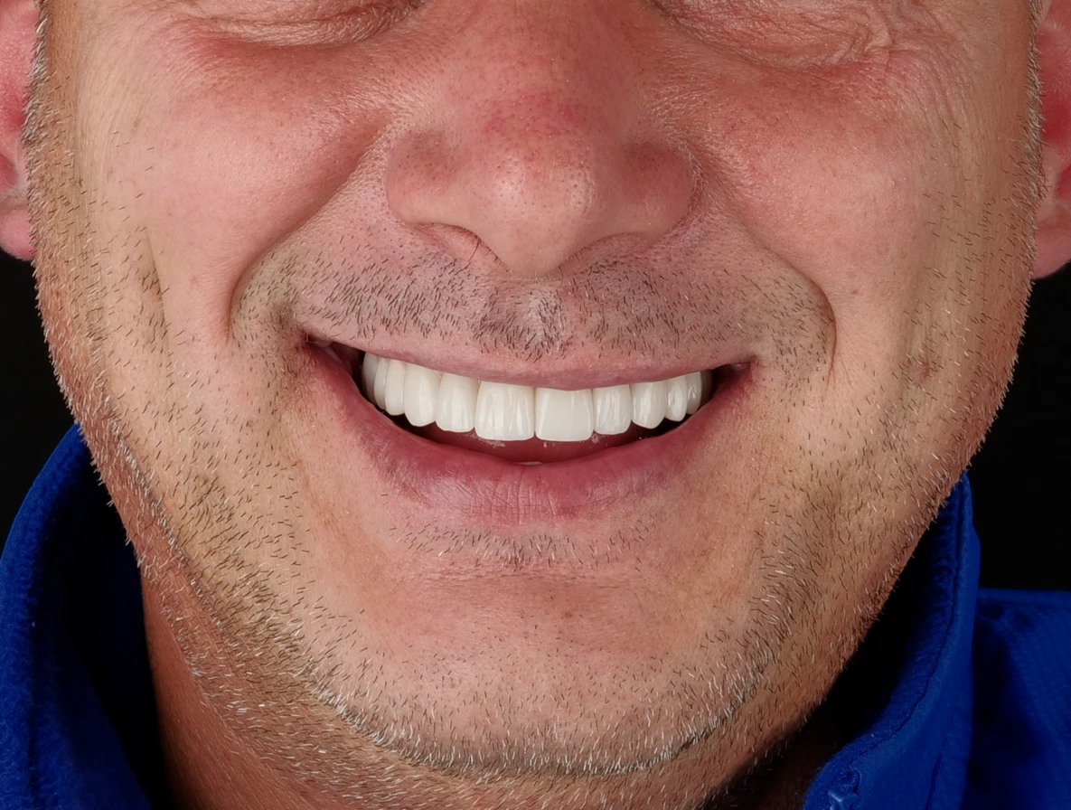 Lucrare definitivă fixă pe implant, la Smileway Timișoara