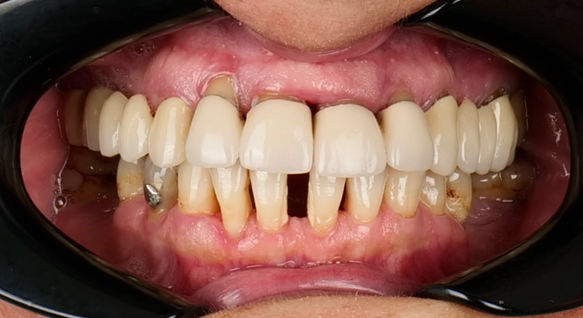 Lucrare protetică veche cu dinți compromiși dedesubt, la Smileway Timișoara