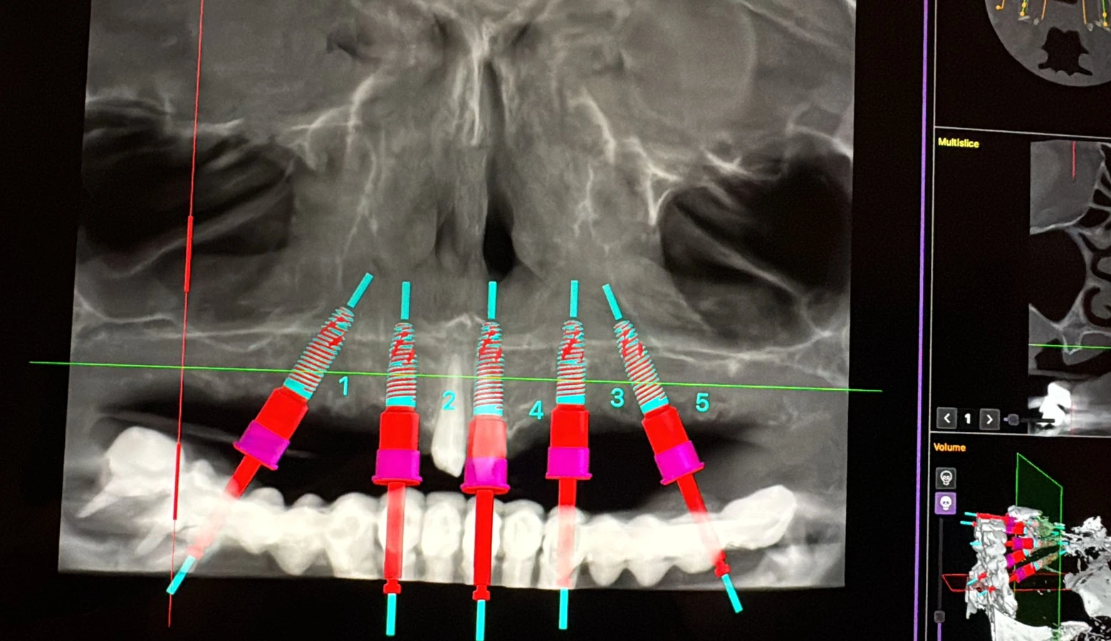 Planificare digitală și radiografie 3D CBCT la Smileway Timișoara