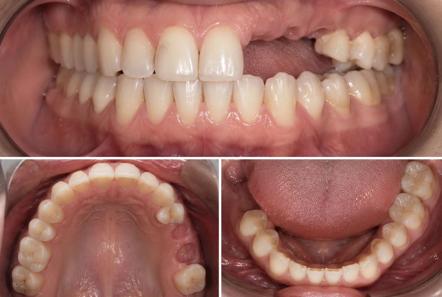 Implant dentar unitar pentru un dinte lipsă, la Smileway Timișoara