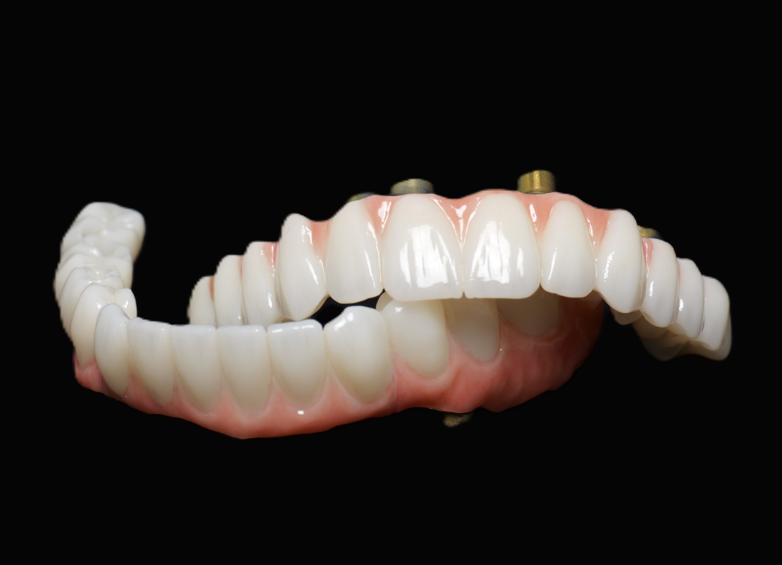 Lucrare fixă pe implanturi, All-on-4 pe mandibulă și All-on-6 pe maxilar, realizată la Smileway Timișoara